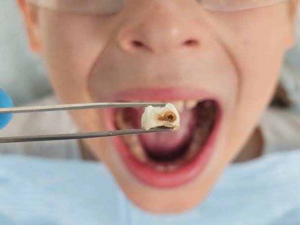 Best Emergency Dental Care for Broken or Chipped Teeth in Lake Kiowa, TX
